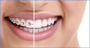 What are braces? Photo