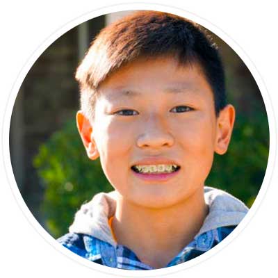 Surgical orthodontics - kid with braces.