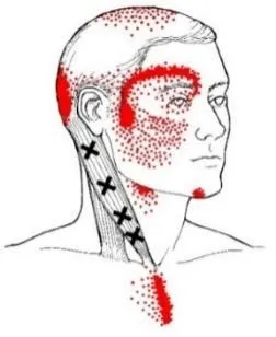 pain-jaw-dysfunction1