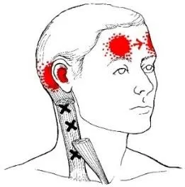 pain-jaw-dysfunction2