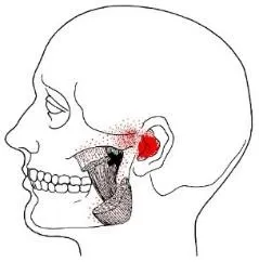 spasms-of-the-deep-masseter