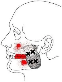 superficial-masseter-muscle