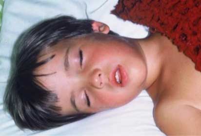 Child sleeping and breathing through mouth.