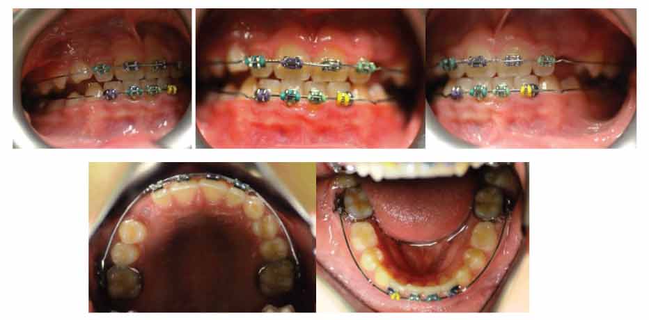 images of teeth and alignment of teeth