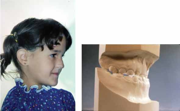 5 ½ year old presented with a concave facial profile with a prominent chin.