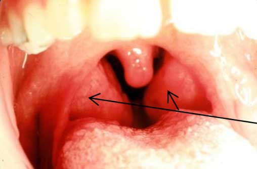 Enlarged tonsils