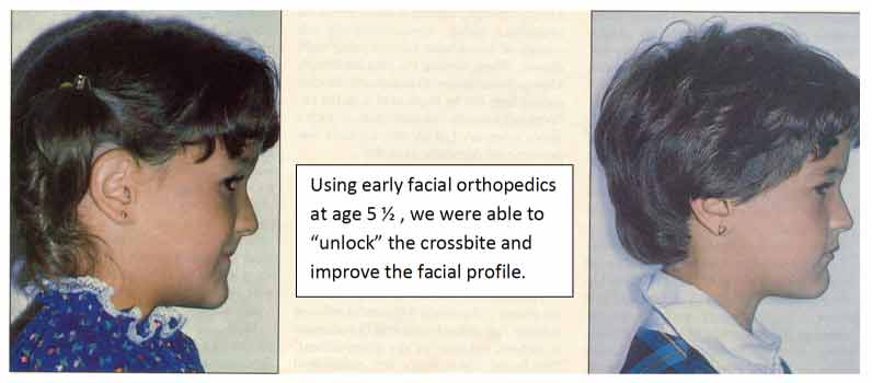 After photos of young girl with improved facial profiile