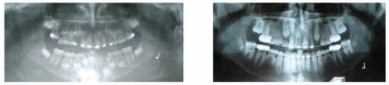 images of upper and lower front teeth