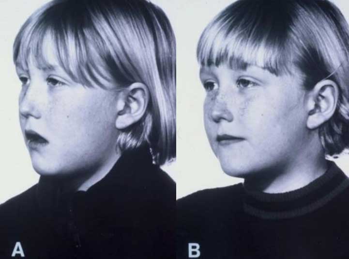 mouthbreathing-girl