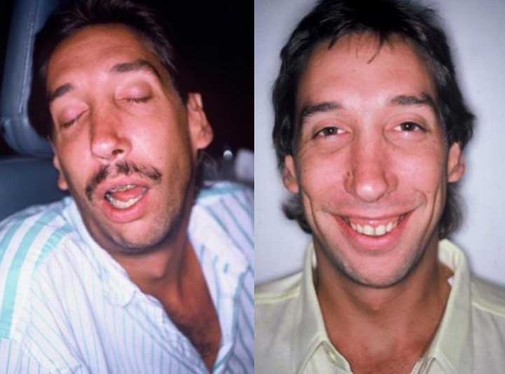 Mouthbreather in adult male