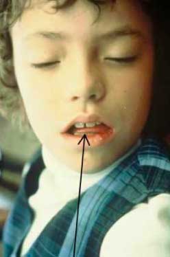 Child mouthbreathing at night while sleeping