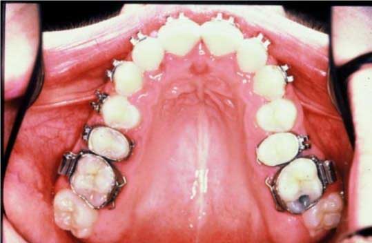 photo of teeth showing treatment progressioin