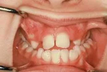 1-open-bite