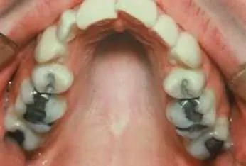 2-narrow-jaw-structure