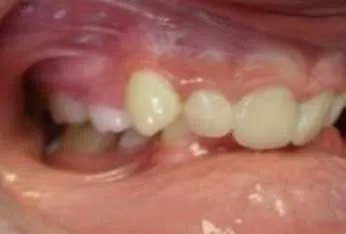 4-dental-retrusion
