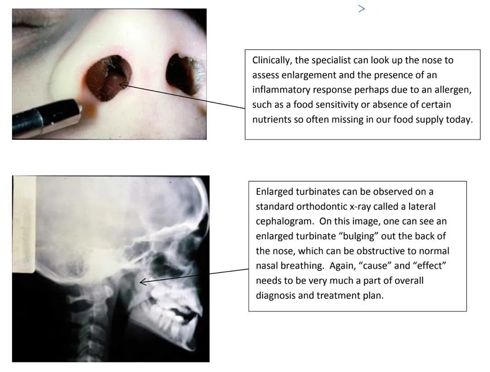 diagnosing-turbinates