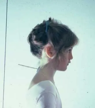 forward-head-posture_