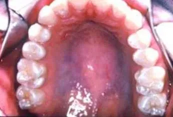 optimal-jaw-structure