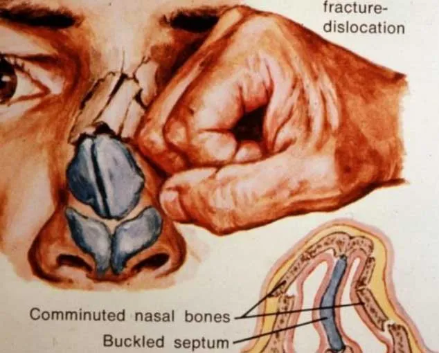 punch-to-nose-deviated-septum