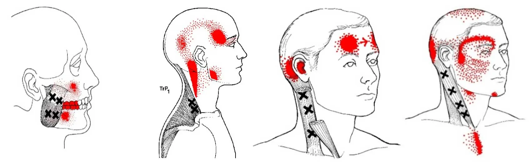 referred-pain-patterns