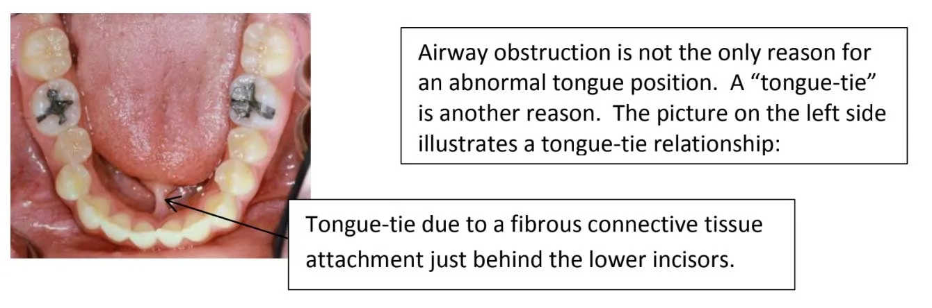 tongue-tie