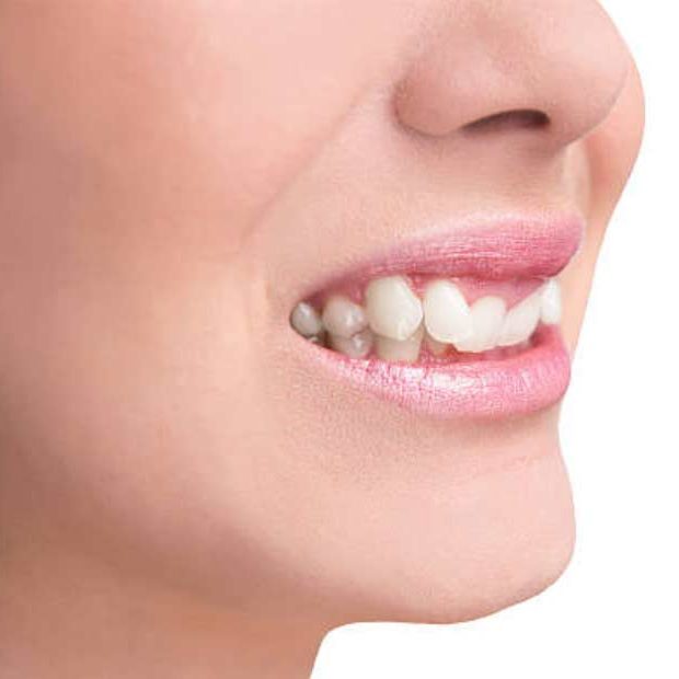 girl with overbite